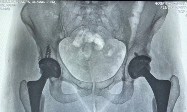 Alejandra Guzmán muestra el daño en su cadera por caída en el escenario