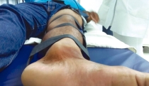 EN ACCIDENTE  Se fractura pierna motociclista
